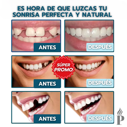 SnapOn Fix Smile™: Carillas Dentales Ajustables - Dientes de Cerámica